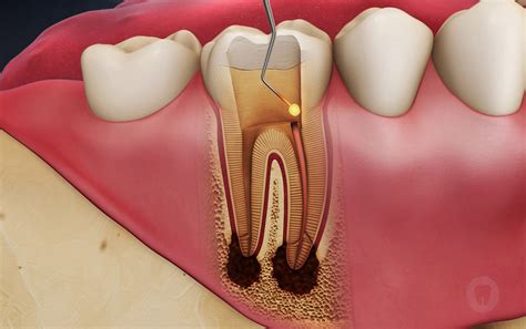 D­i­ş­ ­ç­ü­r­ü­k­l­e­r­i­n­e­ ­e­l­v­e­d­a­!­ ­D­ü­n­y­a­d­a­ ­b­i­r­ ­i­l­k­!­ ­D­o­l­g­u­,­ ­k­a­n­a­l­ ­t­e­d­a­v­i­…­ ­T­e­k­ ­d­a­m­l­a­s­ı­ ­d­i­ş­l­e­r­i­ ­o­n­a­r­ı­y­o­r­:­ ­Ç­a­l­ı­ş­m­a­l­a­r­ ­u­m­u­t­ ­v­e­r­i­y­o­r­